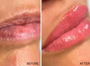 A before and after shot of lips that had gone through lip blushing treatment. The after photo shows perfectly tinted lips.